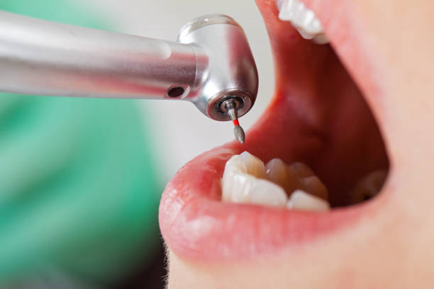 Best Emergency Tooth Extraction in Parkwood, CA
